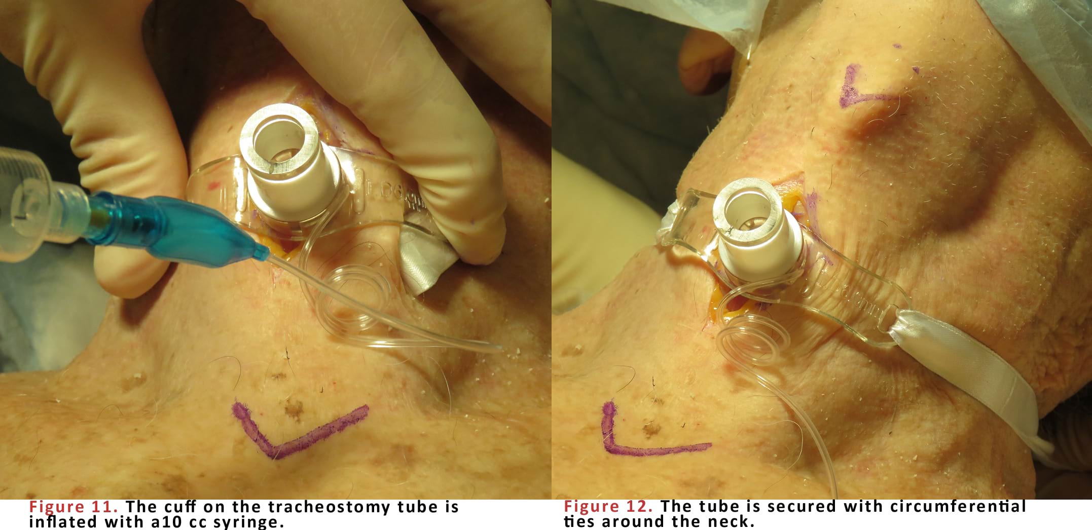 The cuff on the tracheostomy tube is inflated with a 10 cc syringe.