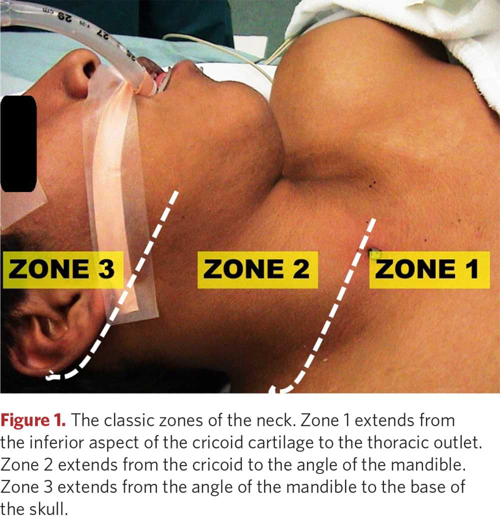 The classic zones of the neck