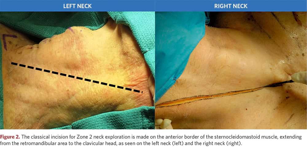 The classical incision for Zone 2 neck exploration