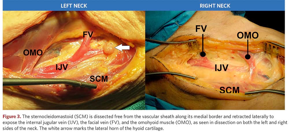 The sternocleidomastoid (SCM)