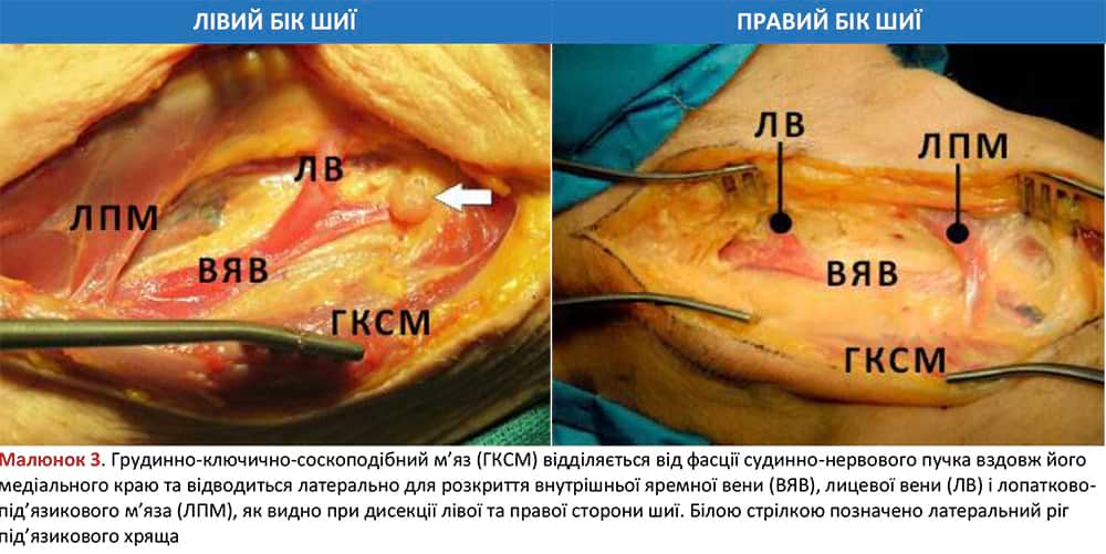 Грудинно-ключично-соскоподібний м’яз