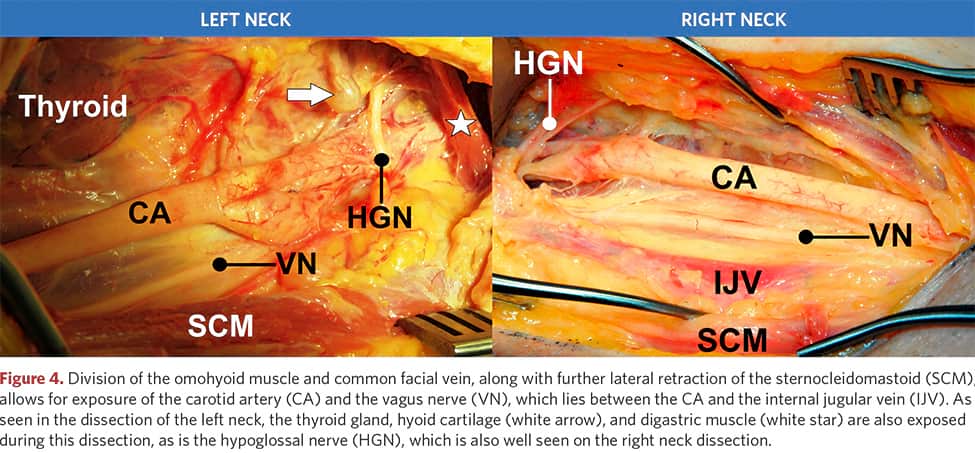 Division of the omohyoid muscle and common facial vein