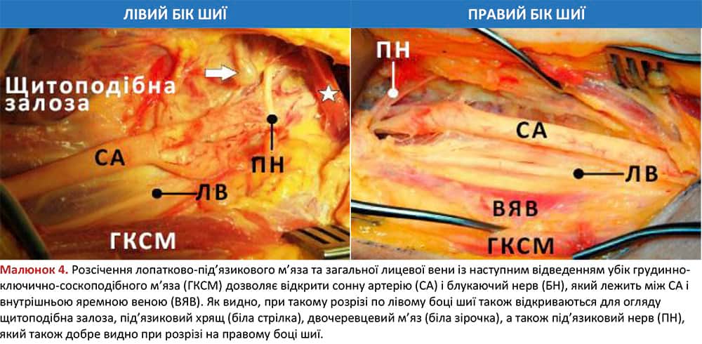 Розсічення лопатково-під’язикового м’яза та загальної лицевої вени