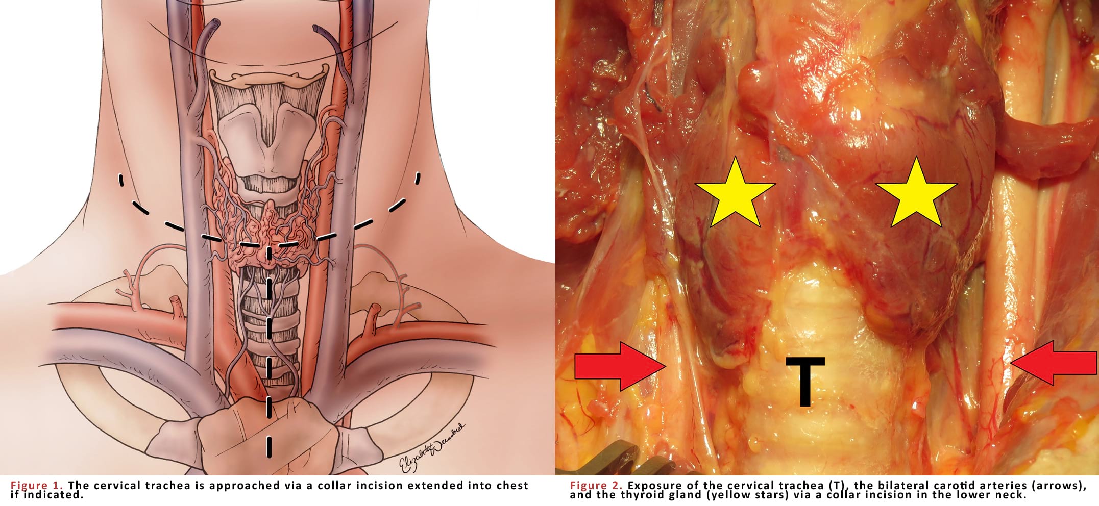 The cervical trachea is approached via a collar incision extended into chest if indicated.