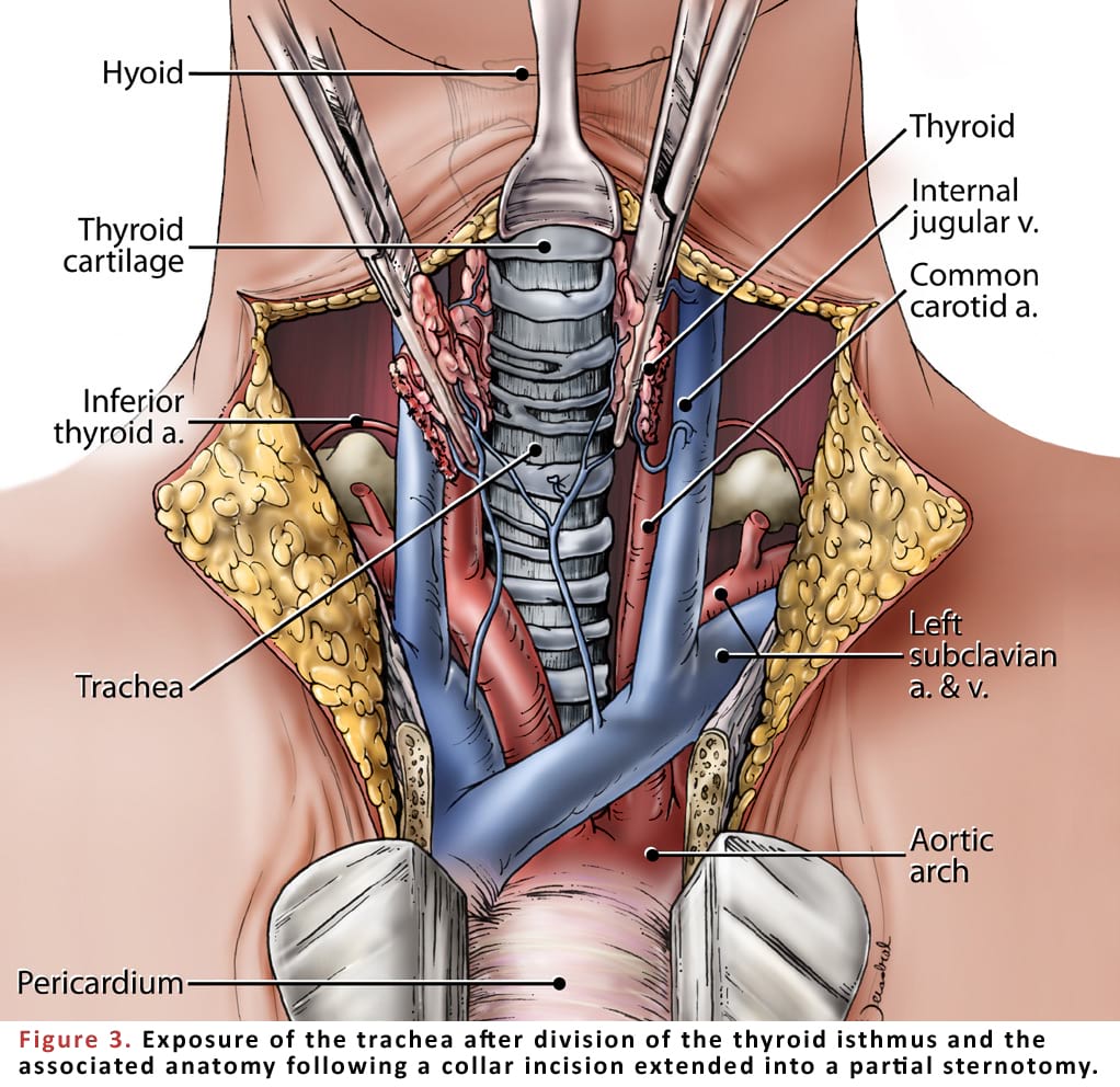 Exposure of the trachea after division of the thyroid isthmus and the associated anatomy following a collar incision extended into a partial sternotomy