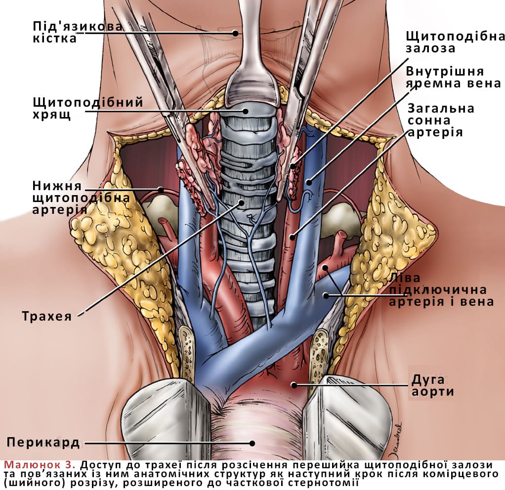 Доступ до трахеї після розсічення перешийка щитоподібної залози