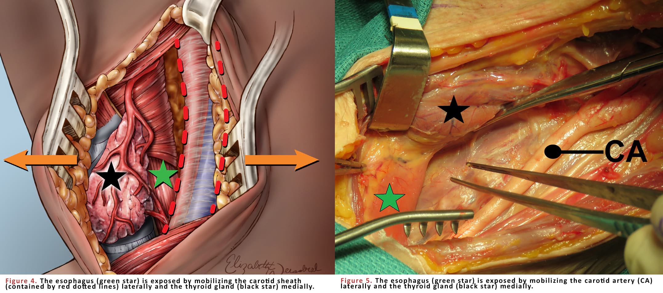 The esophagus is exposed by mobilizing the carotid sheath (contained by red dotted lines) laterally and the thyroid gland medially.