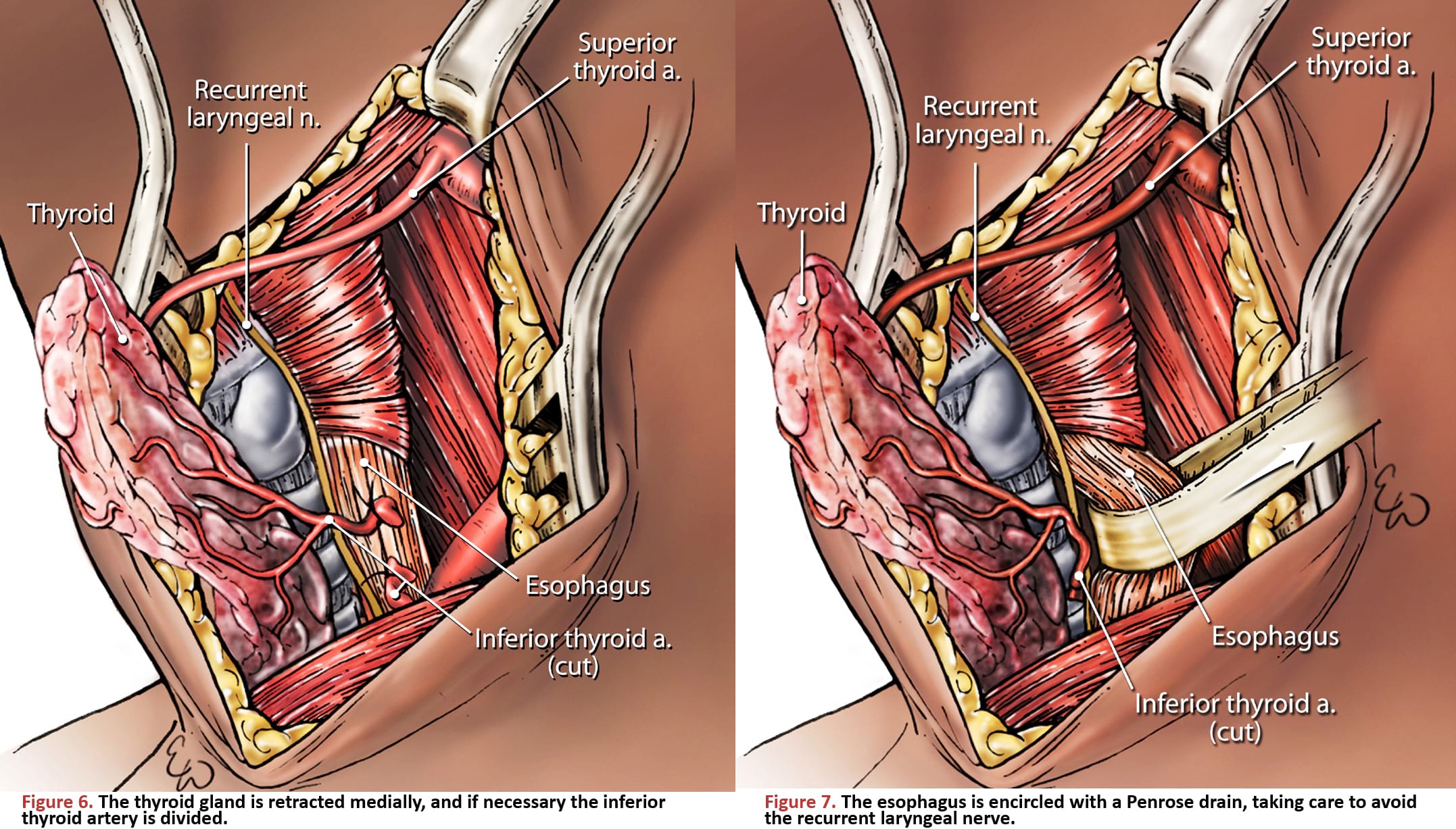 The thyroid gland is retracted medially, and if necessary the inferior thyroid artery is divided