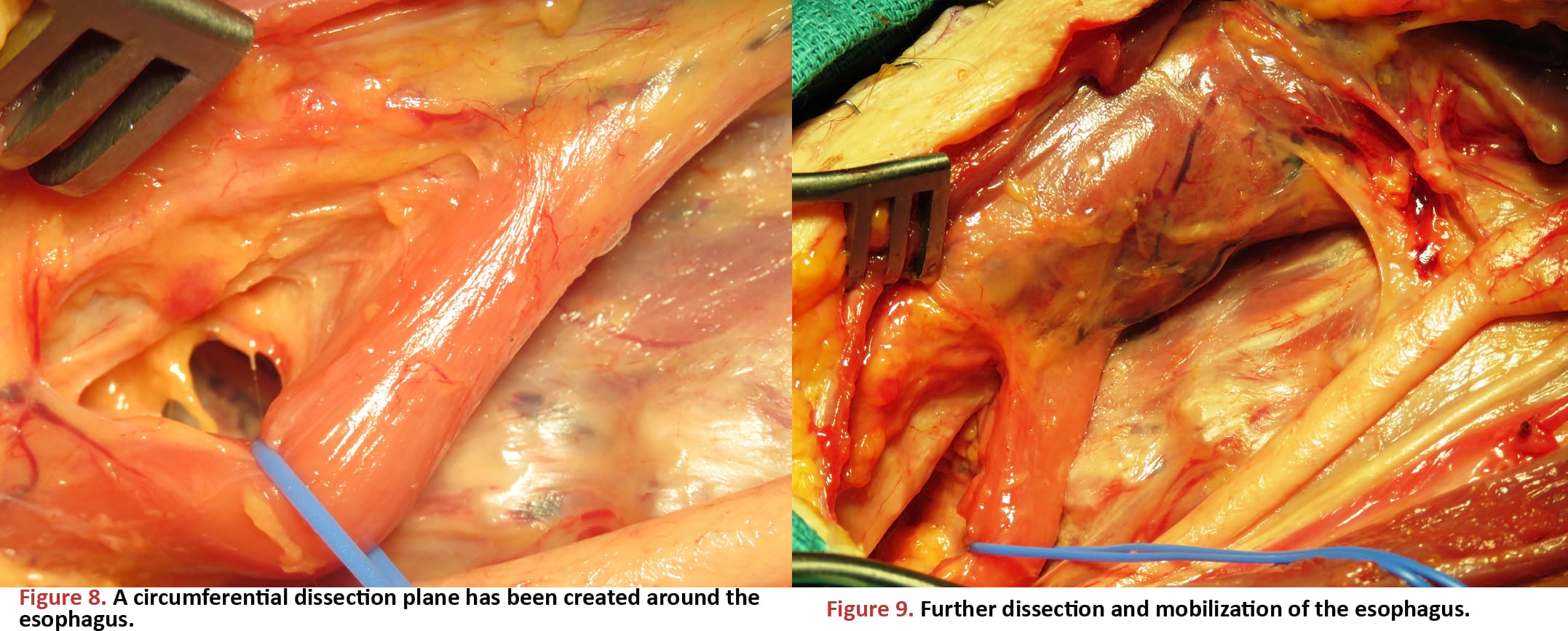 A circumferential dissection plane has been created around the esophagus.