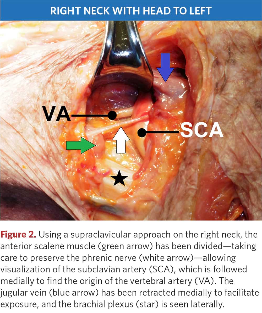 Subclavian and vertebral arteries