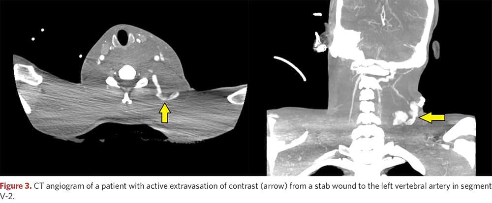 CT angiogram: stab wound of the left vertebral artery