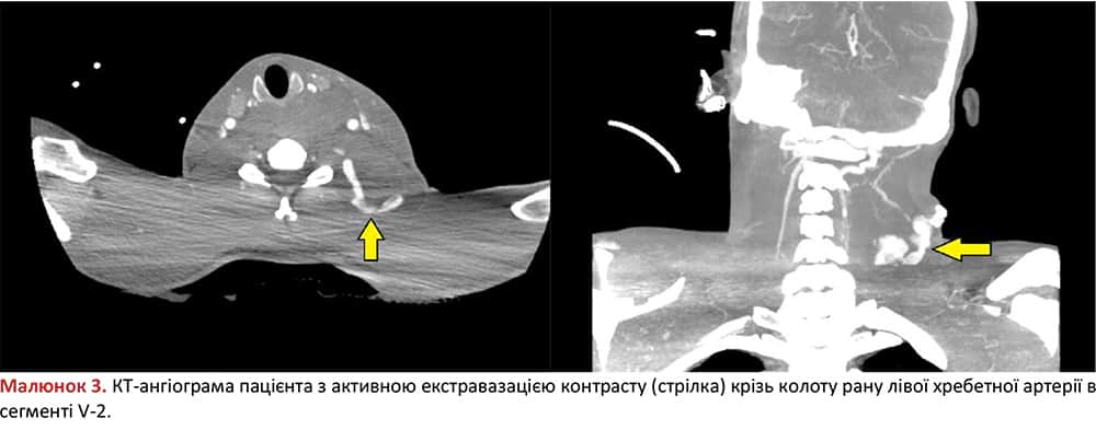 КТ-ангіограма: колота рана лівої хребетної артерії