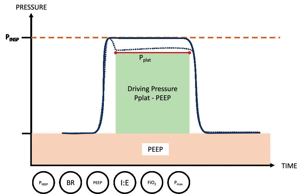 Вентиляція з керованим тиском