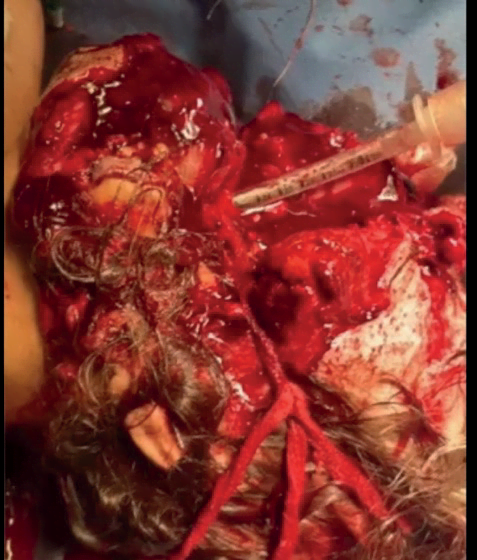 Травми обличчя - CCT