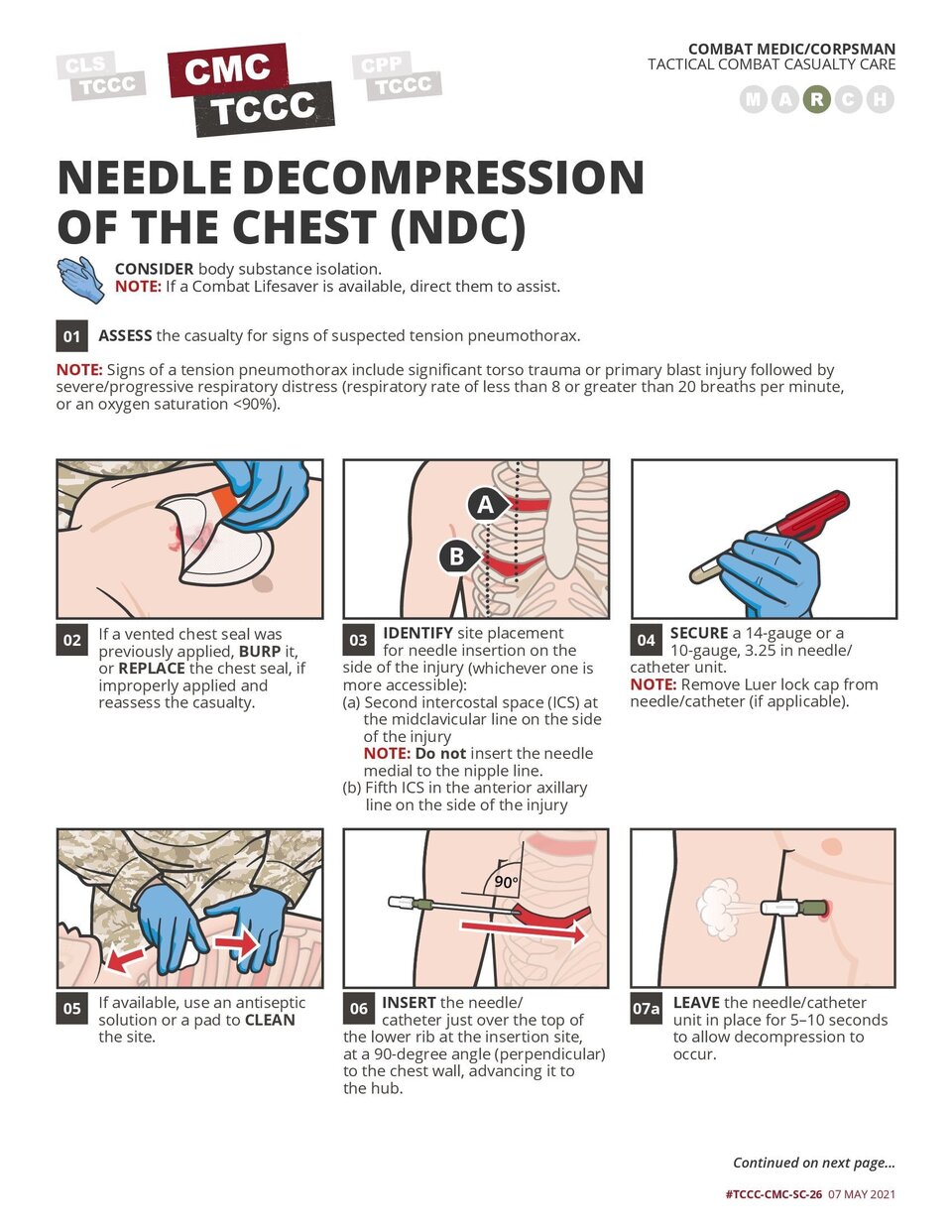 Needle Decompression of the Chest (NDC)