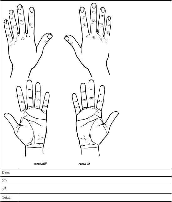 Adult Burn Diagram: Hands