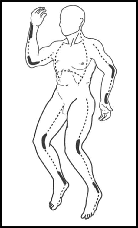 Escharotomy Figure