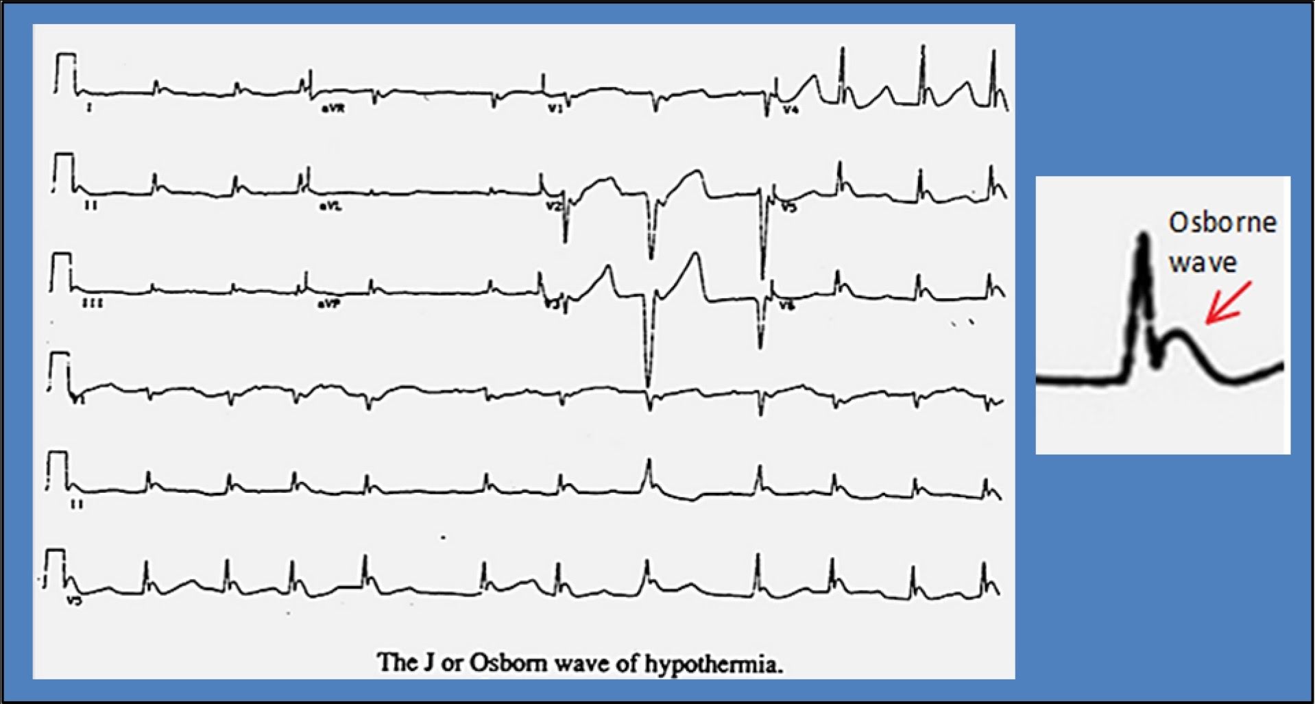 EKG demonstrate Osborn Waves