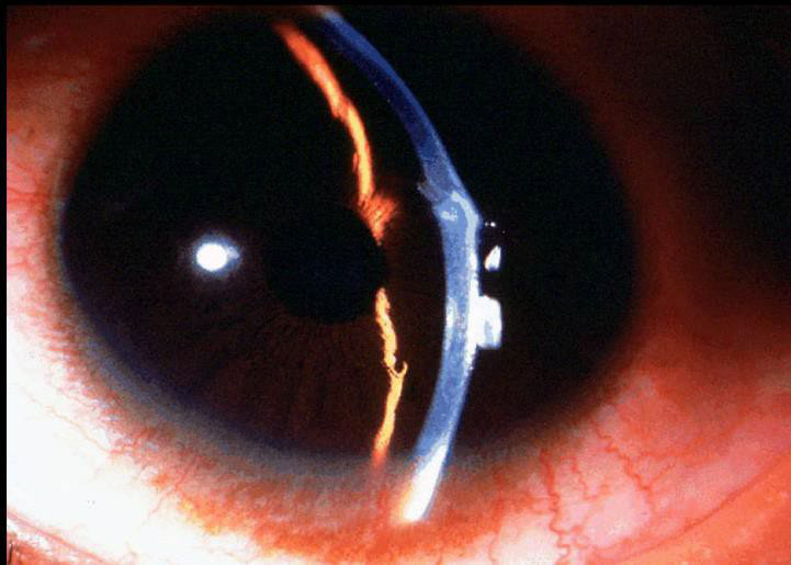 Subtle corneal penetration from foreign body
