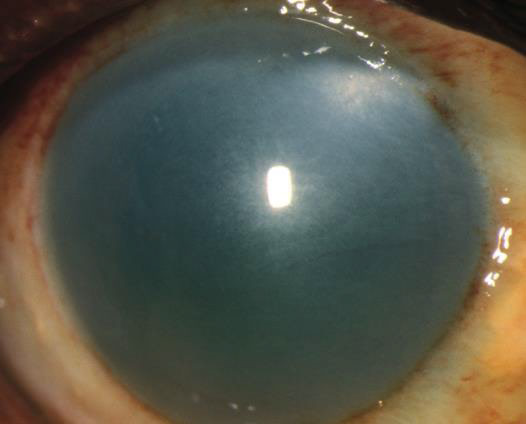 Alkali burn with corneal opacification and blanching of conjunctiva