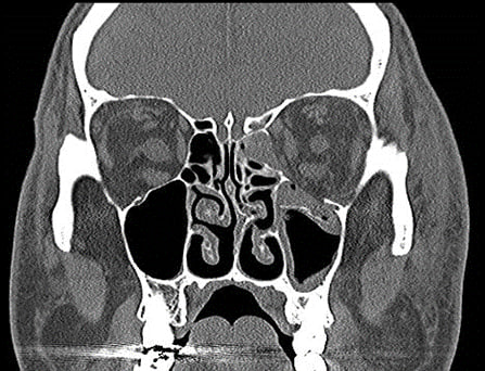 Computed tomography showing left orbital floor and medial wall fractures