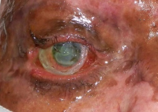 Eye and facial thermal burn. Eye ointment on ocular surface.