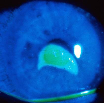 Epithelial defect stains with fluorescein when illuminated with cobalt blue light