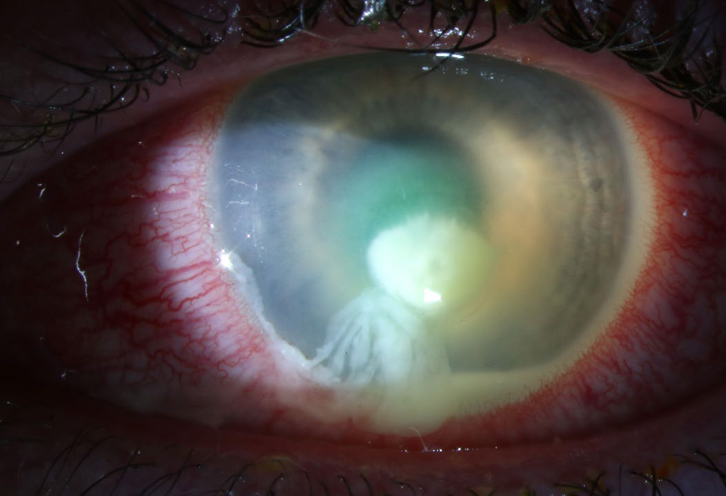 Pseudomonas infectious keratitis (corneal ulcer) from contact lens wear