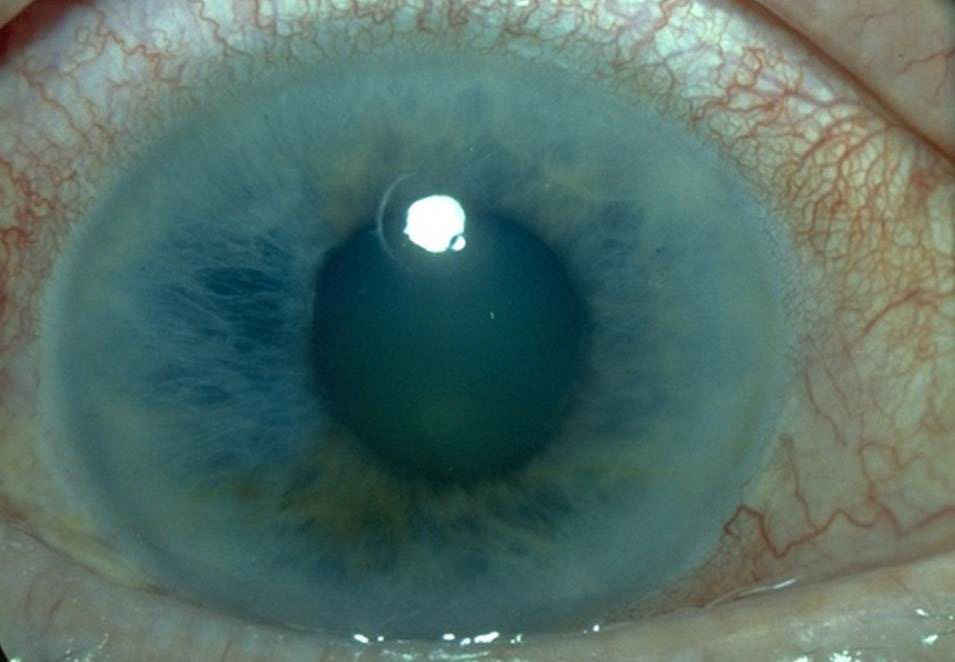 Гостра закритокутова глаукома