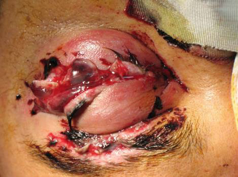 Open globe with eyelid laceration secondary to rubber pellets from nonlethal grenade explosion