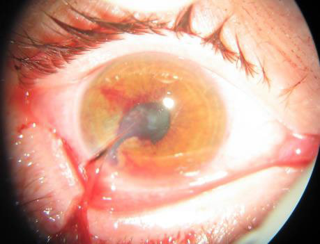 Corneal laceration and eyelid laceration