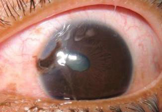 Open globe with peaked pupil and iris prolapse