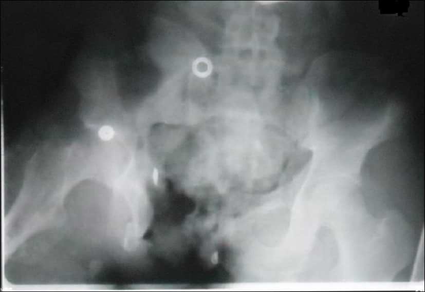 Open Pelvic Ring and Acetabular Fractures