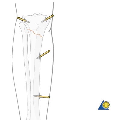 Anterior view of tibia with pins