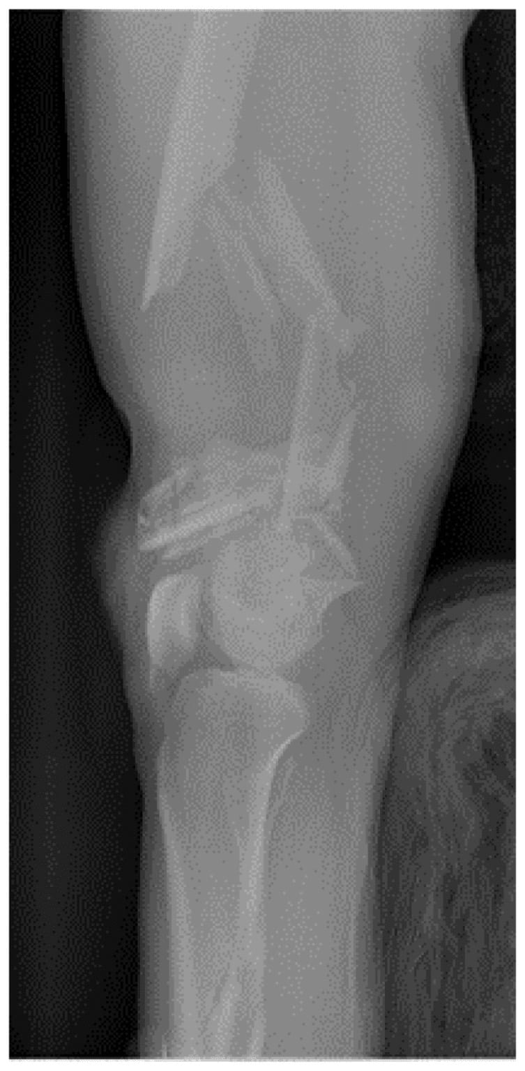 Comminuted distal femoral fracture