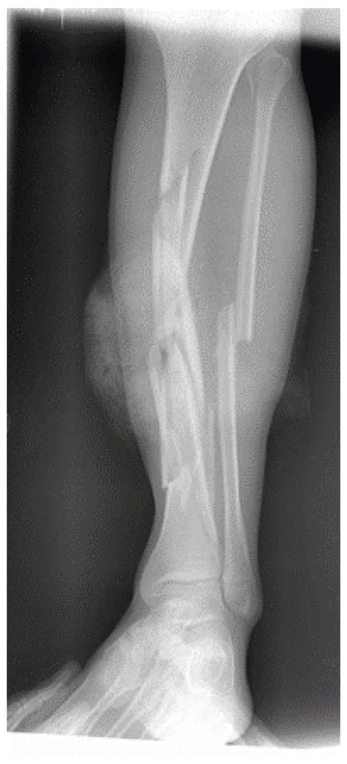 Mid-shaft tibial fractures