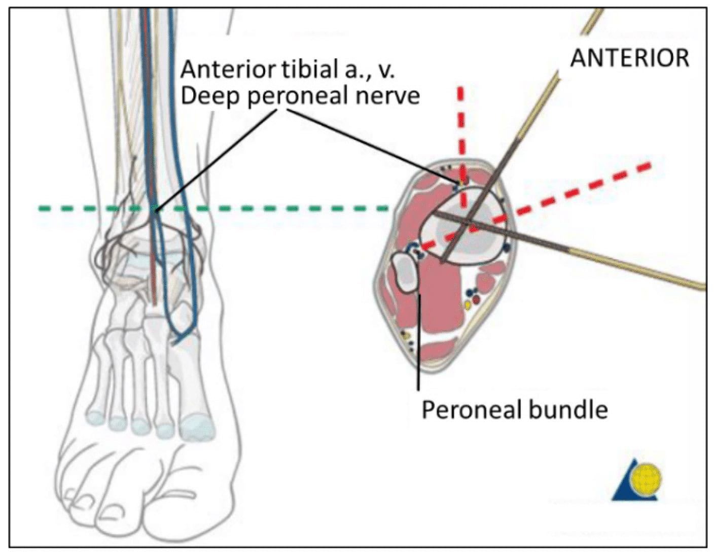 Pin placement for ankle stabilization