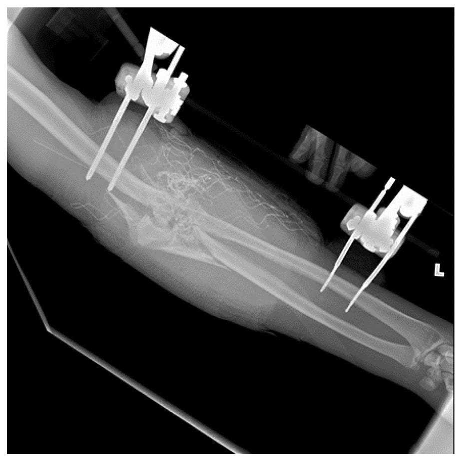 X-ray of distal radial pin