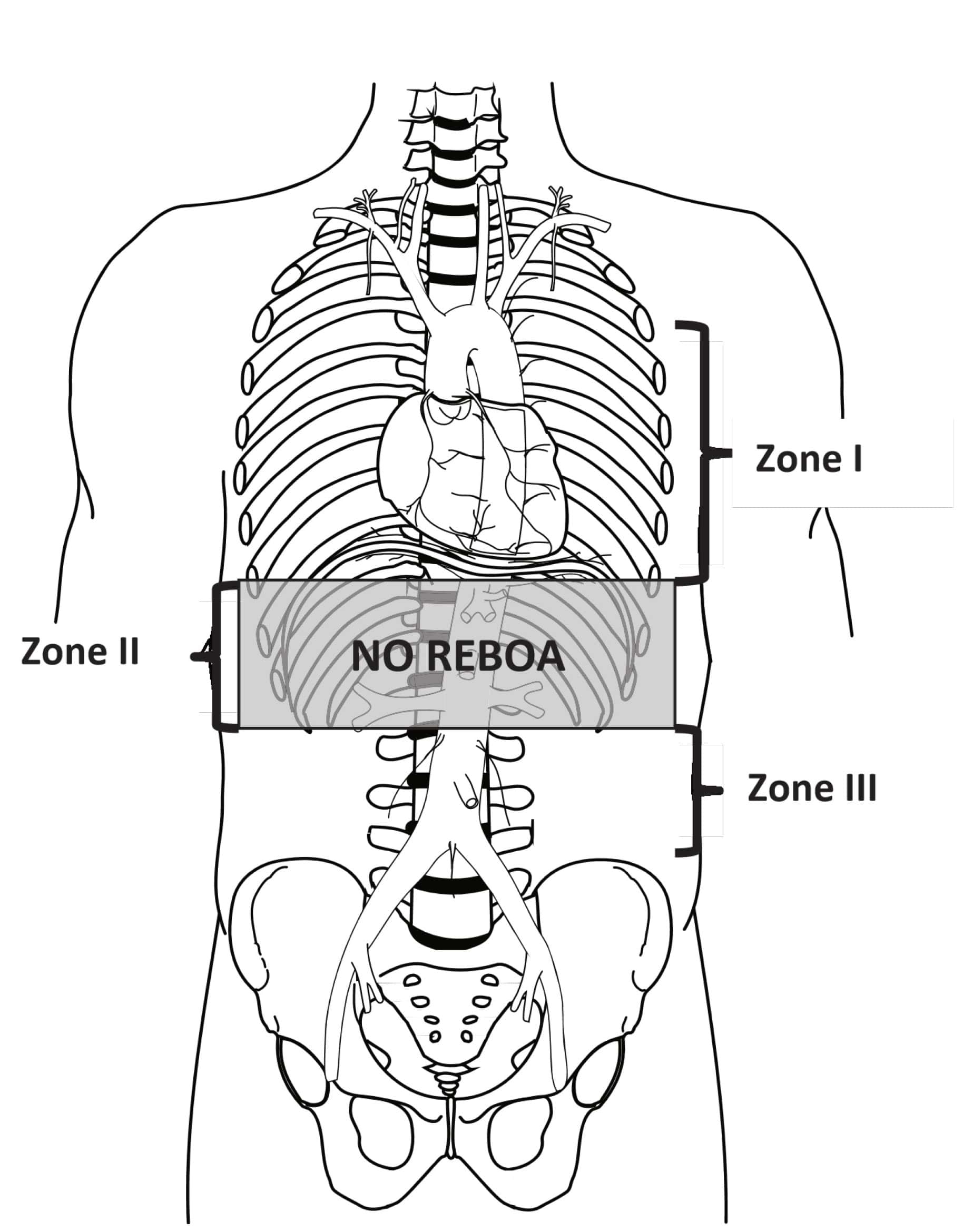 Aortic Zones