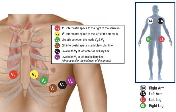 Correct 12-Lead ECG Placement