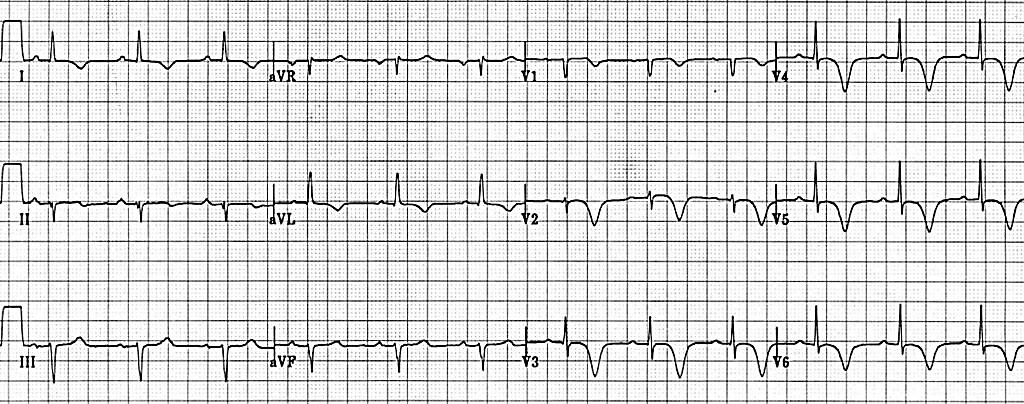 12-lead ECG of STEMI with deep, symmetrical T-wave inversions indicative of Wellen’s syndrome