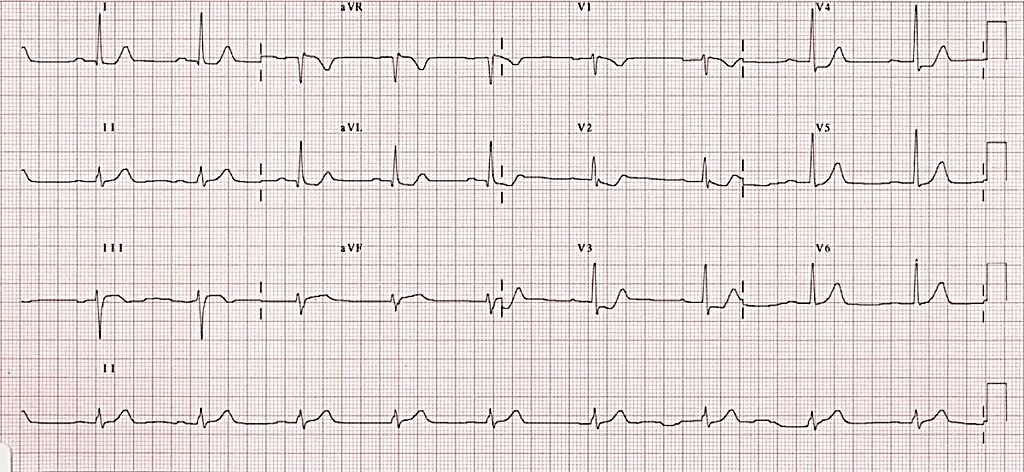 12-lead ECG showing ST-depressions in V2-V3 which is suspicious for posterior STEMI