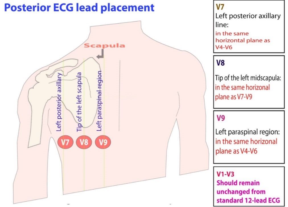 Posterior ECG lead placement