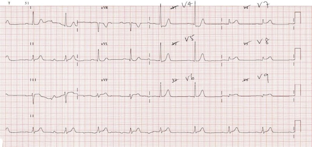 12-lead ECG STEMI Showing posterior STEMI. Notice ST-elevations in posterior leads V7-V9