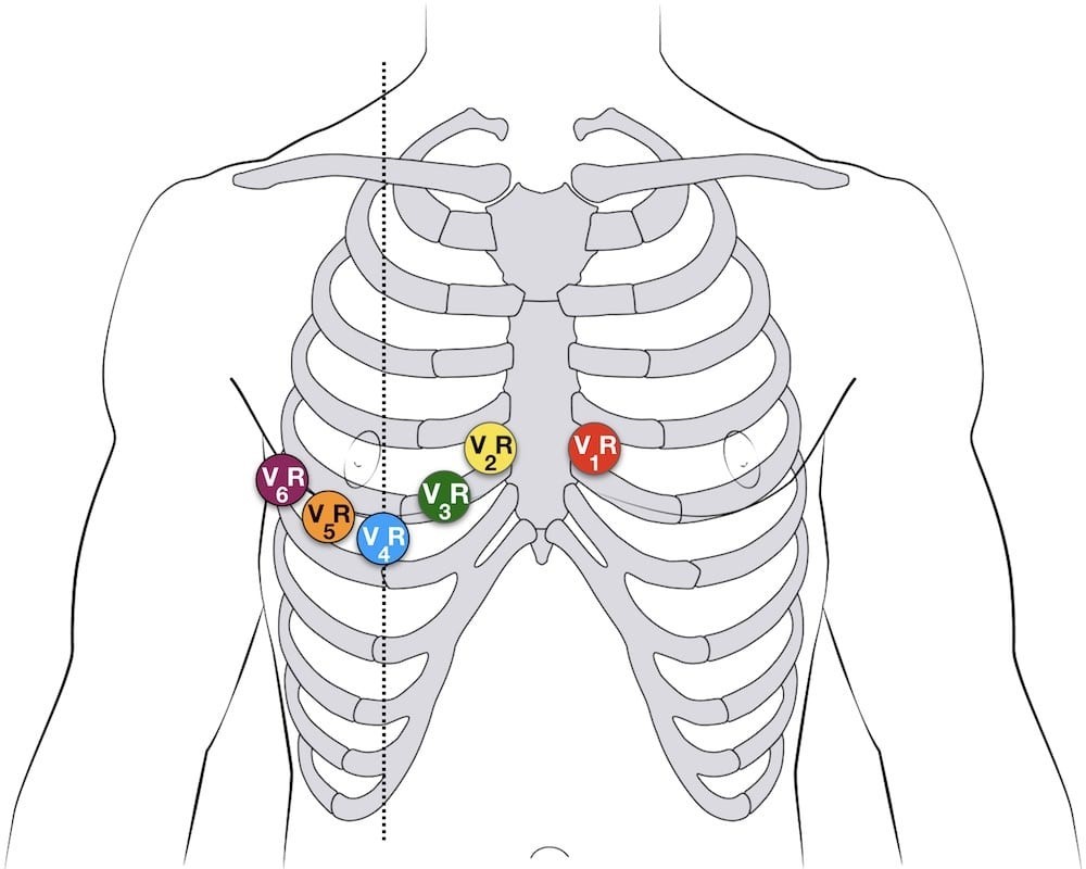 Right-sided ECG lead placement