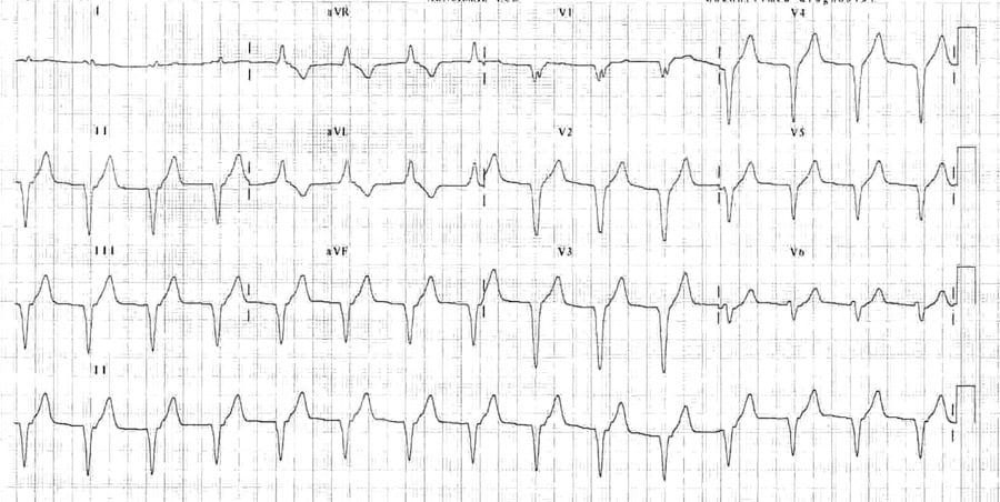 12-lead ECG STEMI Accelerated idioventricular rhythm after STEMI reperfusion