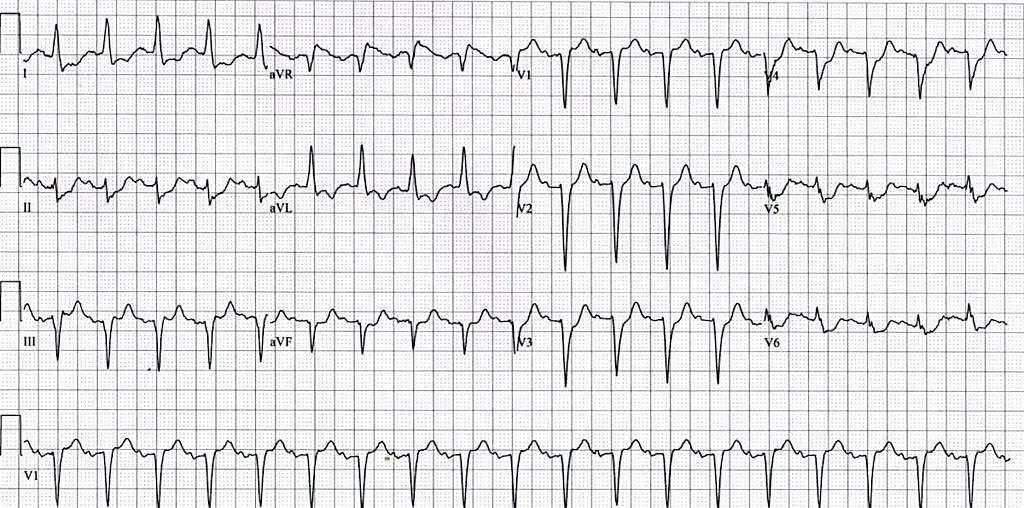 12-Lead ECG of STEMI with left main pattern