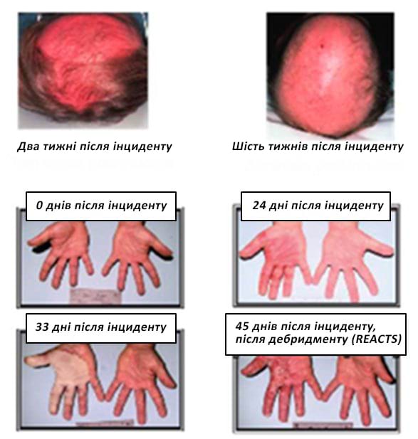 Часові рамки при променевому ураженні шкіри