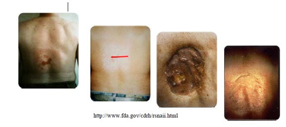 Cutaneous injury from fluoroscopy