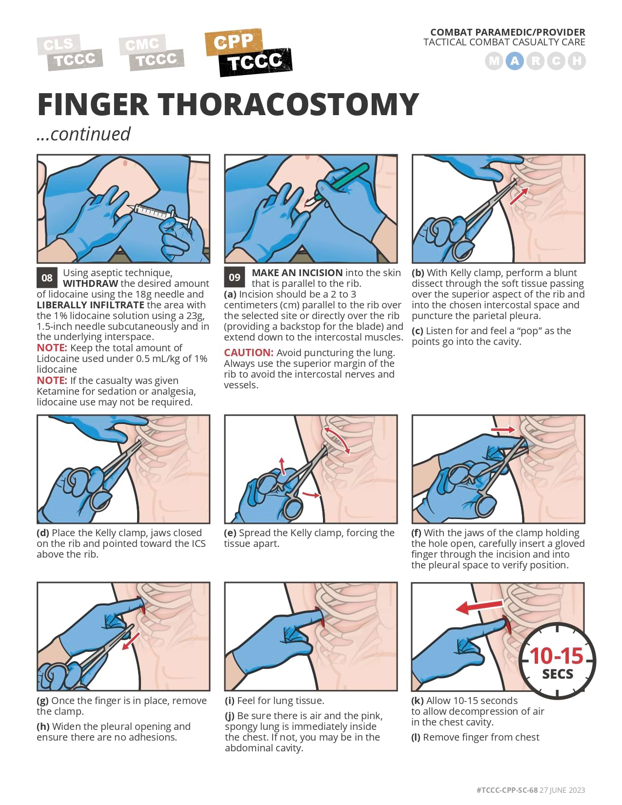 Finger Thoracostomy , cpp, page 2